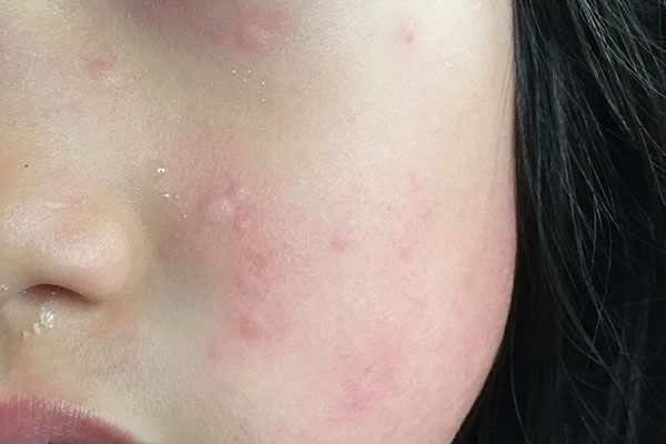 Hives On Face